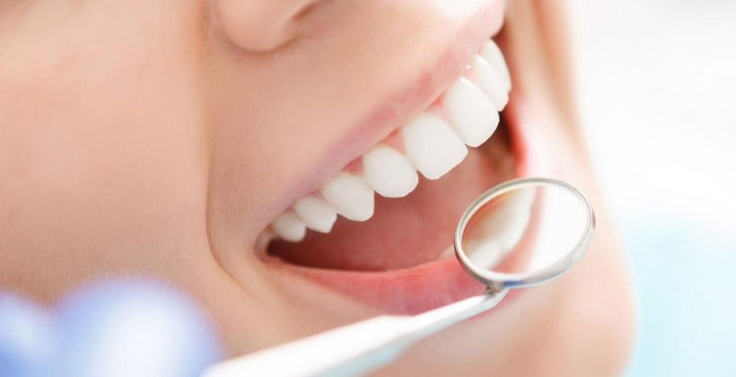 LAMİNATE VENEER LAMİNATE VENEER